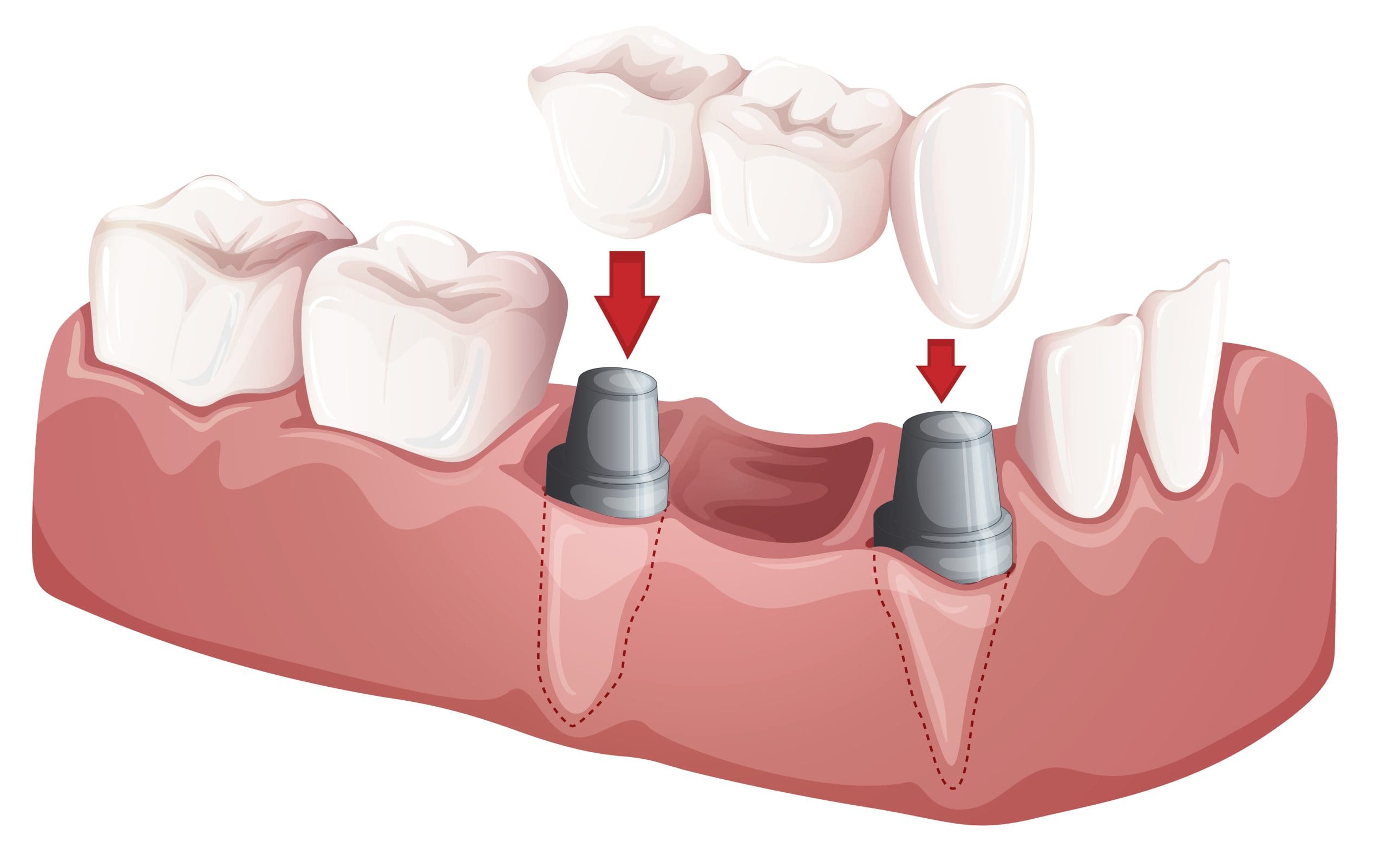 How Dental Implants Work Virginia Beach Edition