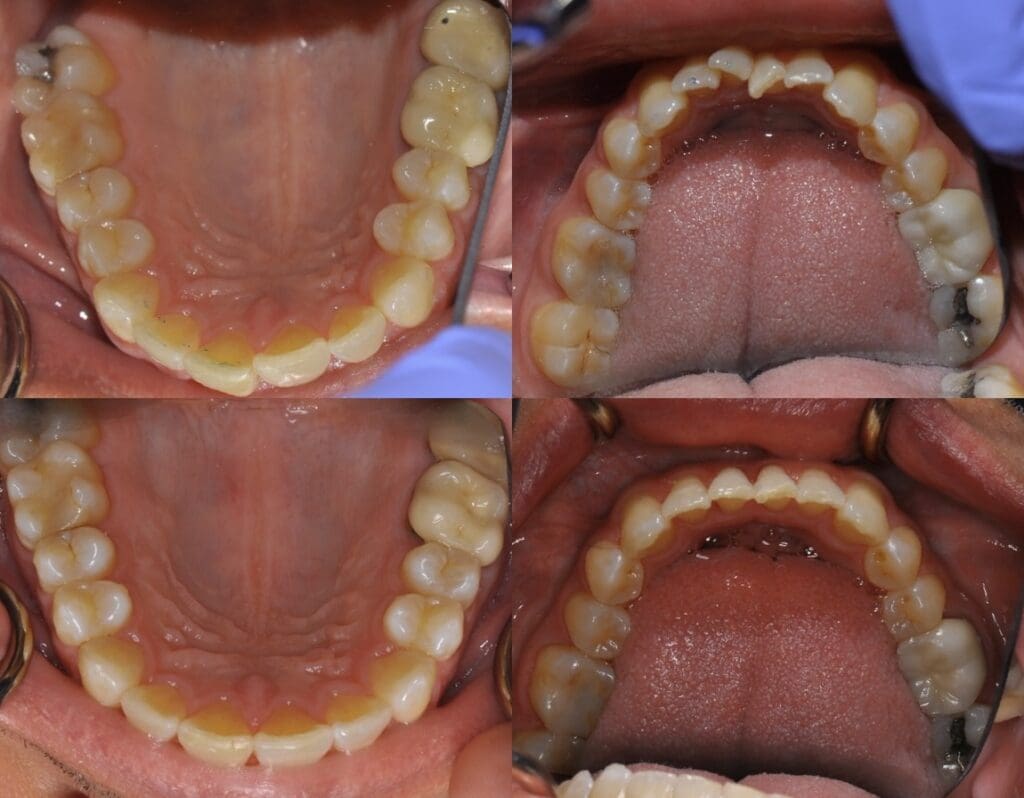 Before and After with Clear Aligners